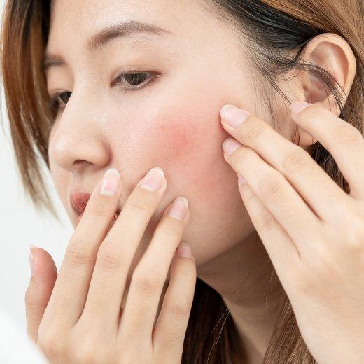 Skin rosacea Skin rosacea