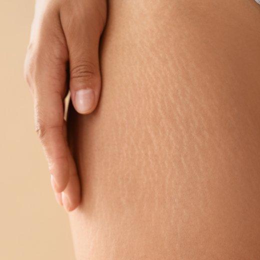 Image of model showcasing stretch marks