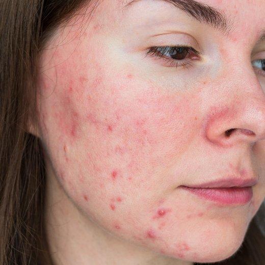 Red Pimples Red Pimples