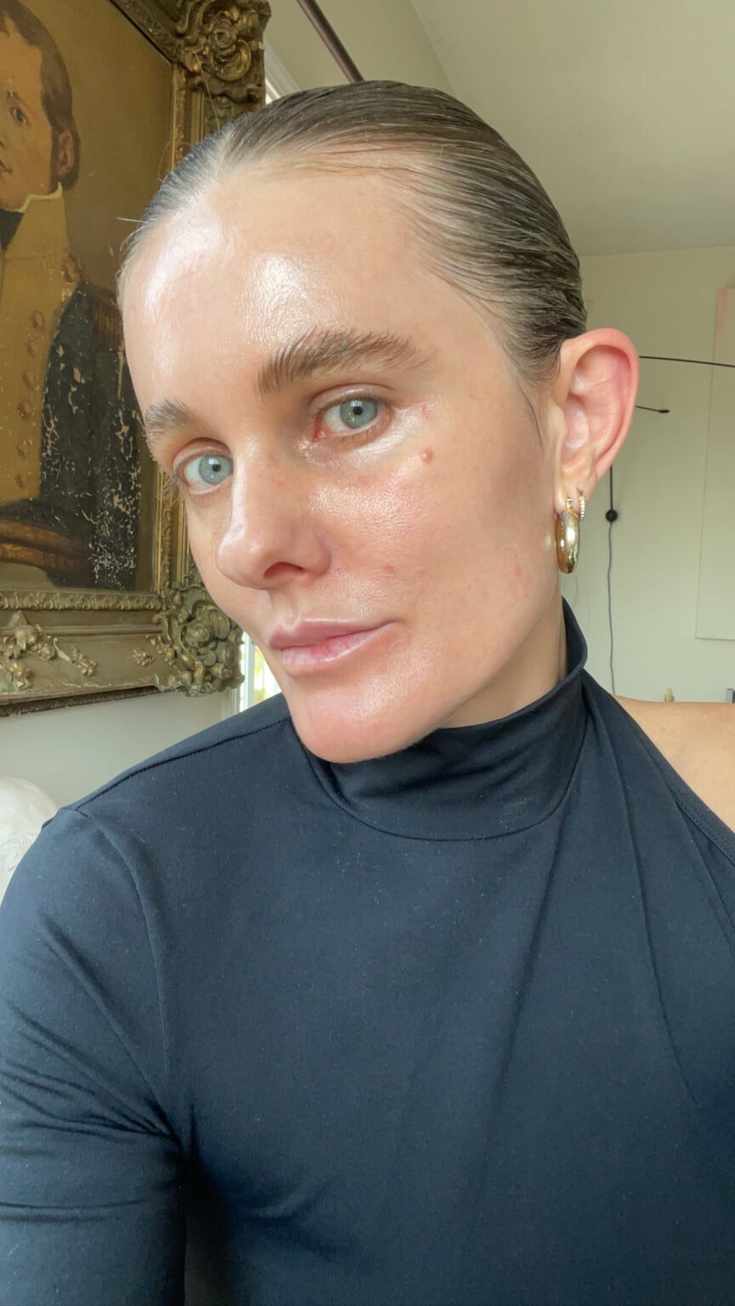 what is microneedling with prp_Sacha Strebe