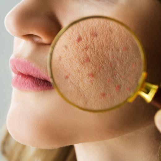 Identifying skin type